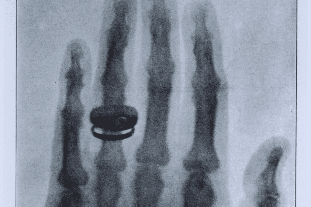 Image of an x-ray of a hand